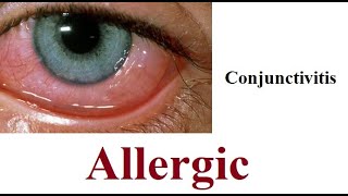 Allergic Conjunctivitis [upl. by Sherj93]