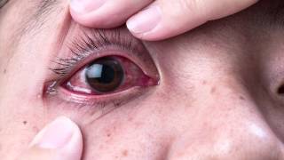 Ask The Expert  Dr Gabriel Sosne  Pink Eye and Viral Eye Infections [upl. by Aelhsa]