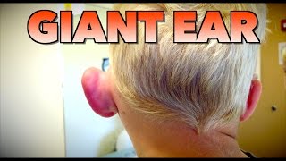 GIANT EAR Allergic Reaction or Infection  Dr Paul [upl. by Scherman665]