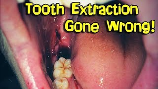 Wisdom Teeth Removal Extraction [upl. by Ahsyle]