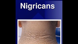 Acanthosis Nigricans [upl. by Ahtelra]