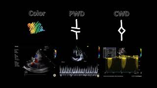 Spectral Doppler [upl. by Rinee]