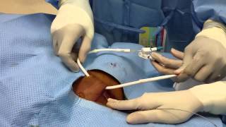 Tunneled Dialysis Catheter Insertion [upl. by Christen88]