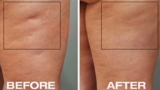 New tool to fight cellulite [upl. by Nered]