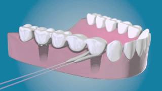 Rengör kring dina tandimplantat med TePe Bridge amp Implant Floss [upl. by Naujtna]