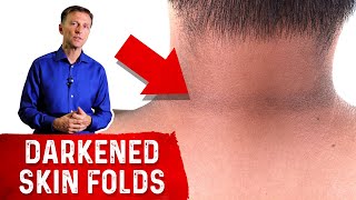 How to Reverse Acanthosis Nigricans [upl. by Adnaugal961]