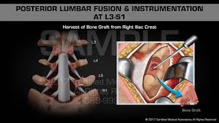 Posterior Lumbar Fusion amp Instrumentation at L3S1 [upl. by Nylareg]