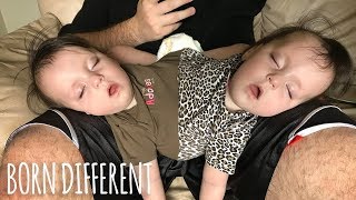 Conjoined Twins Are A Medical Miracle  BORN DIFFERENT [upl. by Aznofla928]