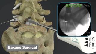 Sciatica Surgery Dr John Small  Florida Orthopaedic Institute [upl. by Adni]