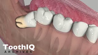 Impacted Tooth Removal [upl. by Alakam]