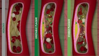 ATHEROSCLEROSIS and CARDIOVASCULAR DISEASE [upl. by Ecirtnahs]