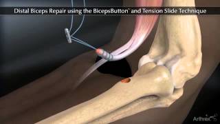 Arthrex Distal Biceps Button Tension Slide Technique [upl. by Esoj10]