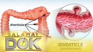 Salamat Dok Information about diverticulitis [upl. by Ennire759]