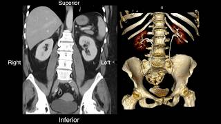 Normal Renal Anatomy [upl. by Sicard]