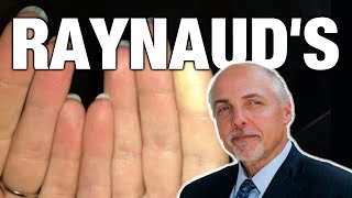 5 natural remedies for RAYNAUDS [upl. by Analos]