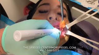 Buccal Fat Removal at The Spiegel Center [upl. by Starks]