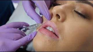 Lip Fillers  what to expect during the procedure  The Laser amp Skin Clinic [upl. by Vassar]