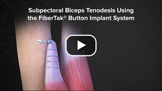 Subpectoral Biceps Tenodesis Using the FiberTak® Button Implant System [upl. by Barrington191]