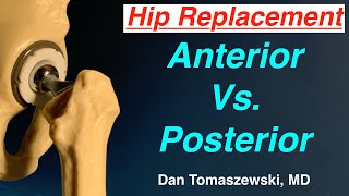 Anterior Vs Posterior Hip Replacement [upl. by Atarman]