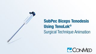 SubPec Biceps Tenodesis Using TenoLok®  CONMED Animation [upl. by Kristo]