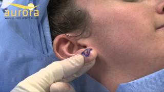 Stretched earlobe repair  Aurora Clinics [upl. by Ayanad]