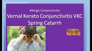 Ophthalmology 088 a Vernal KeratoConjunctivitis VKC Spring Catarrh Allergic Horner Tranta Eye [upl. by Udenihc]