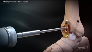 Minimally Invasive Ankle Fusion [upl. by Cleopatra]