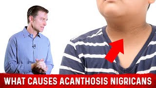 What Causes Acanthosis Nigricans Darkened Skin Folds – Dr Berg [upl. by Tiffany]