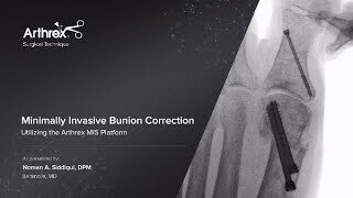 Dr Trevor Williams  Evans Calcaneal Osteotomy  CONMED Surgical Technique [upl. by Annaiek]