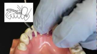 Ribbond Periodontal Splint Technique [upl. by Derrej45]