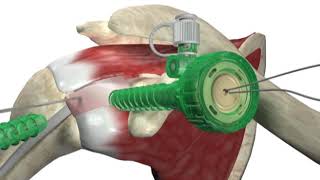 Biceptor Tenodesis System  Surgical Technique Walkthrough  SIMON MOYES [upl. by Legge]