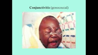 Conjunctivitis  CRASH Medical Review Series [upl. by Saideman]