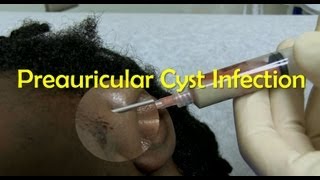 Preauricular Cyst Infection Management [upl. by Moe]