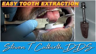 Easy Tooth Extraction  Dental Minute with Steven T Cutbirth DDS [upl. by Tichonn]