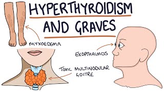 Scleroderma Systemic Sclerosis  Signs Symptoms Pathophysiology  Rheumatology [upl. by Chinua493]