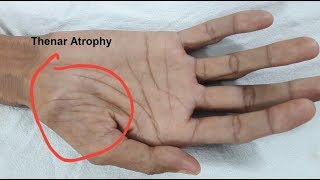 Thenar Atrophy in Motor Neuron Disease [upl. by Cordy]