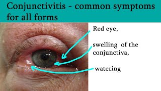 Red or pink eye  Conjunctivitis symptoms and treatment [upl. by Eirelav]