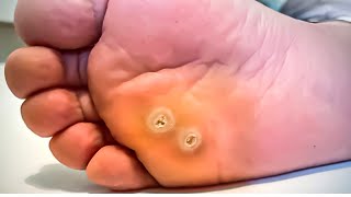 How To Remove a Foot Corn or Callus Foot Doctor Home Treatment [upl. by Chap]