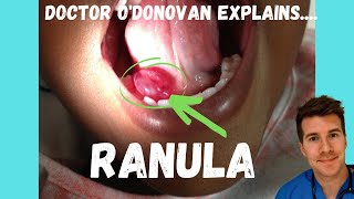 Explaining a Ranula or Mucocele  With Dr ODonovan [upl. by Farra992]