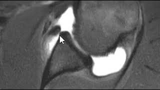 Shoulder MRI Scan  Inferior Shoulder Dislocation [upl. by Yanehc92]