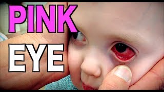 PINK EYE Live Diagnosis Conjunctivitis  Dr Paul [upl. by Behrens687]