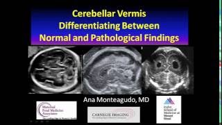 AIUM Webinar Cerebellar Vermis [upl. by Nabala]