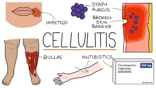 Understanding Cellulitis Skin and Soft Tissue Infections [upl. by Schrader]