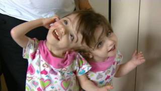 Conjoined Twins Twin Girls A Medical Wonder [upl. by Haggar]