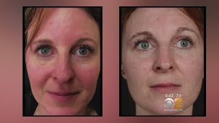 Health Watch New Laser Treatment For Rosacea [upl. by Naras]