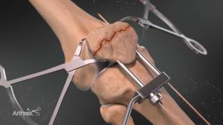 The Arthrex Patella Fracture System [upl. by Mosby]