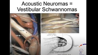 A Rare Brain Tumor Affecting Hearing amp Balance  Acoustic Neuroma [upl. by Enniroc]