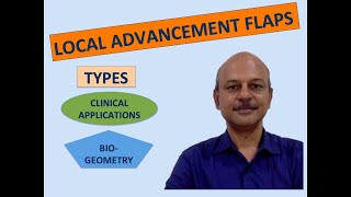 Periodontal surgery Modified Widmann flap [upl. by Nerej]