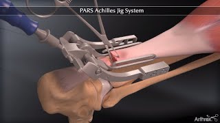 PARS Achilles Jig System [upl. by Conney914]