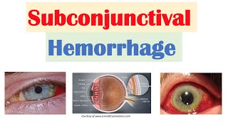 Subconjunctival Hemorrhage Blood in Eye  Causes Signs amp Symptoms Diagnosis Treatment [upl. by Ibbor]